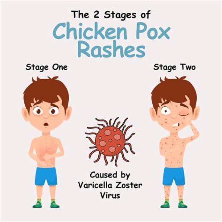 Can we eat egg in chicken pox