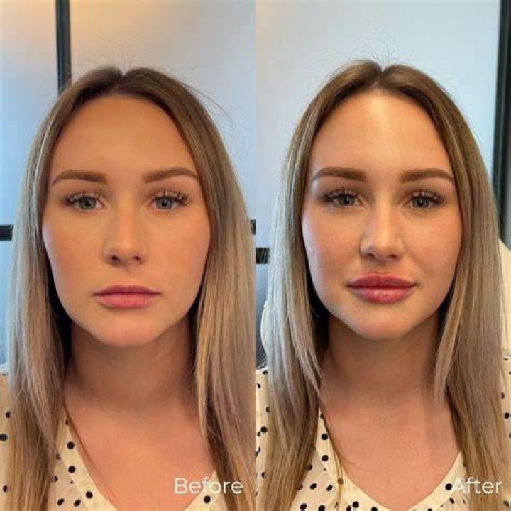 Did Mikayla Nogueira Get Her Lips Done? Plastic Surgery Before And After