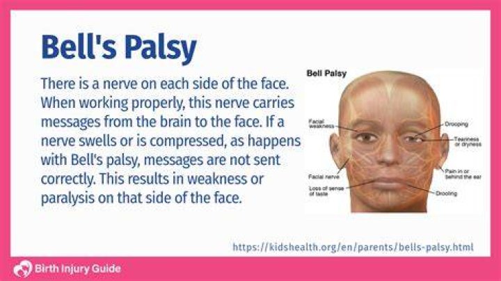 Is Carolyn Warmus Still In Jail? Has She Had Face Stroke aka Bell’s Palsy?