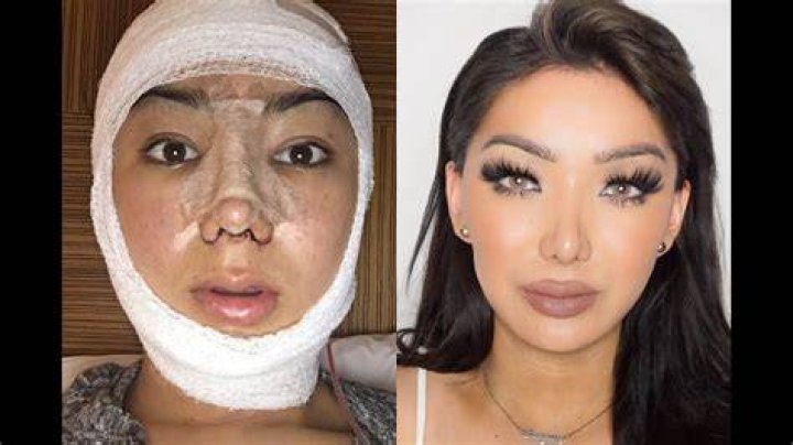 What Happened To Nikita Dragun? Before And After Surgery
