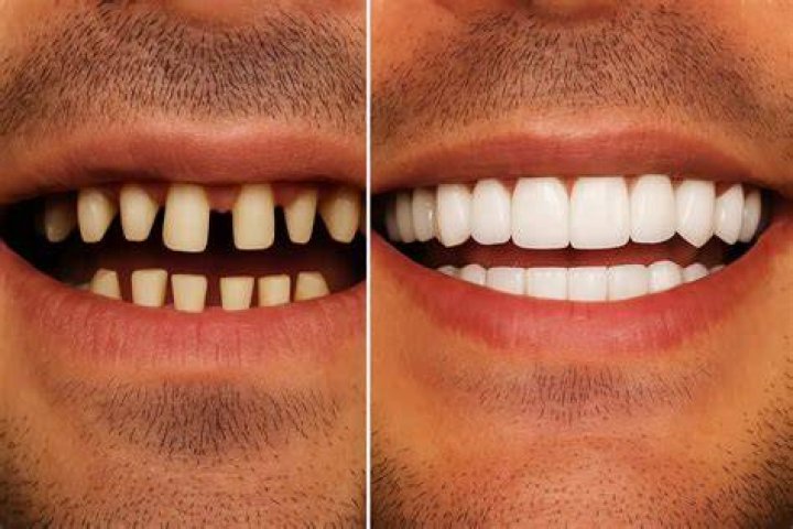Why Is Rex Ryan Teeth Too White? Did He Use Veneers? Before & After Photos Compared!